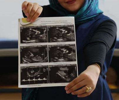 سونوگرافی سه ماهه اول بارداری با روش پیشرفته